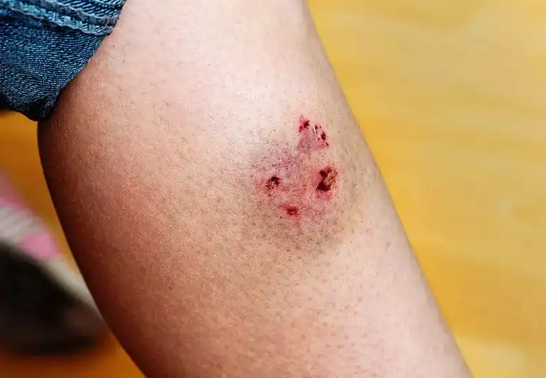 Dog Bite