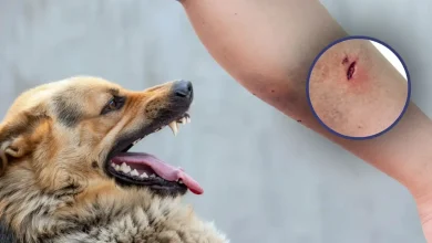 Dog Bite